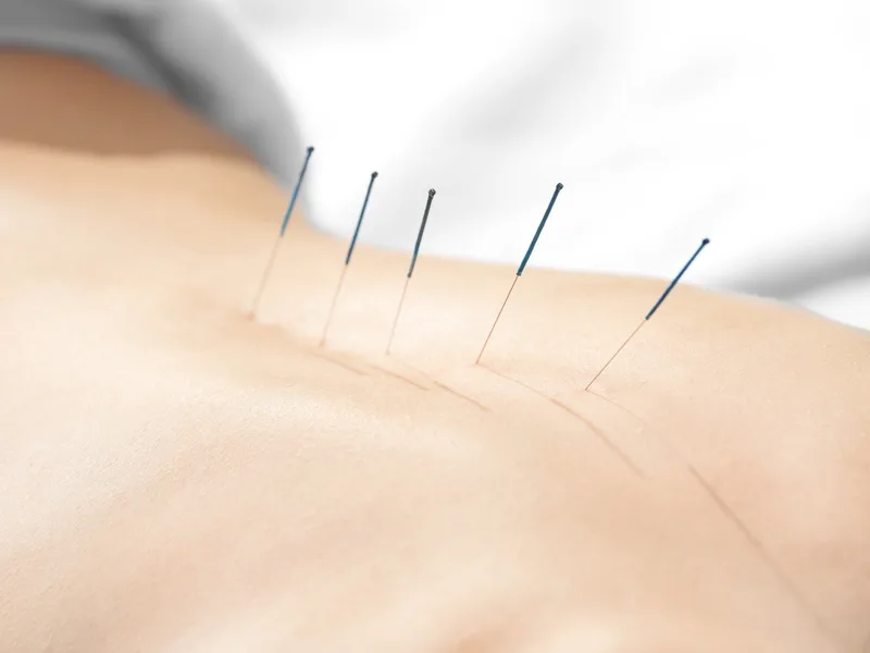 Acupuncture at Demo Chiropractic in Demo City