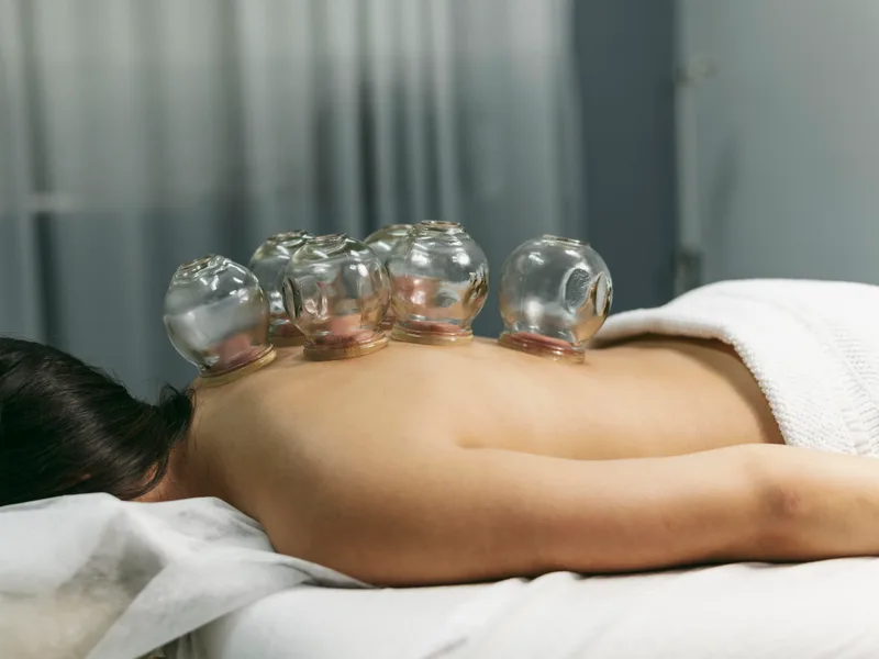 Cupping Therapy at Demo Chiropractic in Demo City