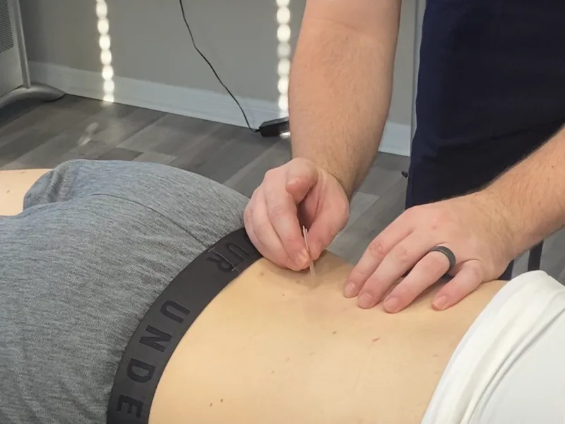How Dry Needling works at Demo Chiropractic