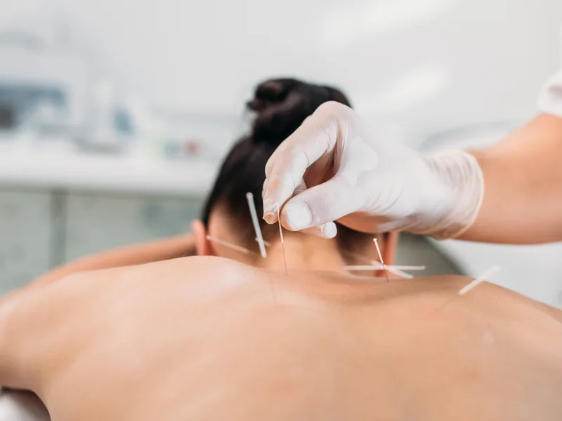 Dry Needling at Demo Chiropractic in Demo City
